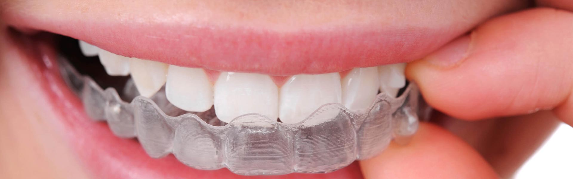 3 Reasons Why Invisalign May Be the Solution For You