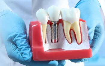 Dental Implants v/s Dentures: What’s Right for You?
