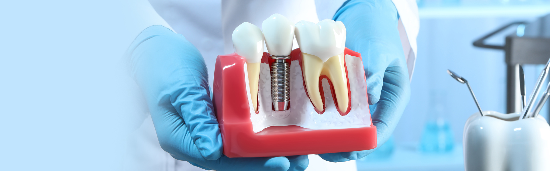 Dental Implants v/s Dentures: What’s Right for You?