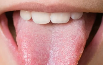 Everything you need to know about Lip and Tongue Ties